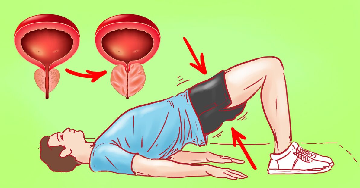 Therapeutic exercises in chronic prostatitis