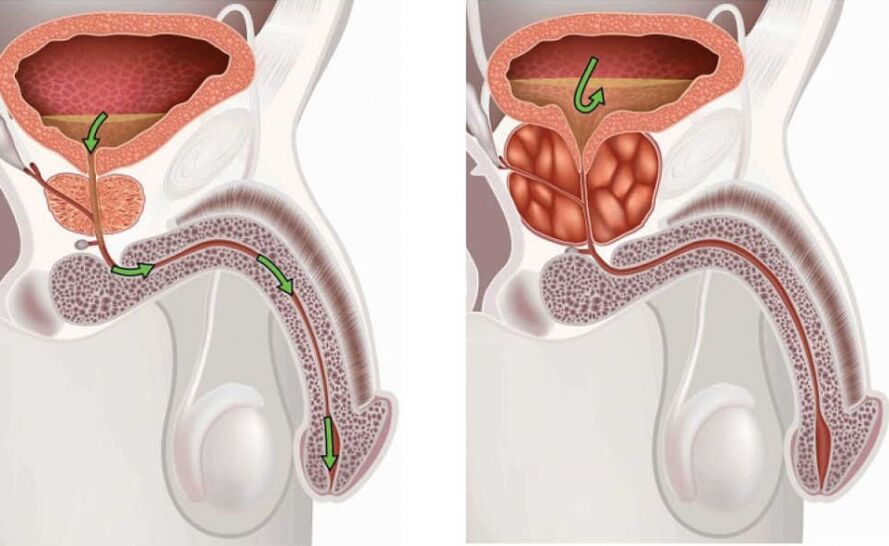 healthy and inflamed prostate