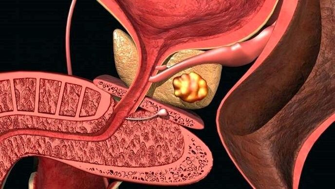 Stone deposits in the prostate in calcific prostatitis