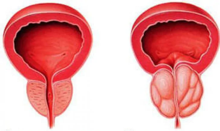 Normal prostate (left) and inflamed chronic prostatitis (right)